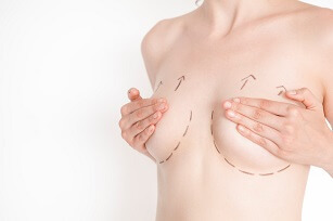 Woman with marks on her breasts for cosmetic surgery